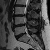 stenoza kanału kręgowego rezonans przedoperacyjny, widok z boku 