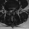 stenoza kanału kręgowego rezonans przedoperacyjny, projekcja osiowa 