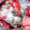 zdjęcie śródoperacyjne droga dojścia do IV komory mózgu 