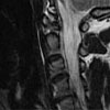 obraz rezonansu magnetycznego z bardzo dużą wypukliną dysku szyjnego ze znacznym uciskiem na rdzeń kręgowy 2