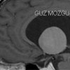 obraz rezonansu magnetycznego guza III komory przekrój z boku