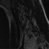 obraz rezonansu magnetycznego, łagodny  guz przykręgosłupowy- przekrój boczny