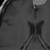 obraz rezonansu magnetrycznego -niewielki oponiak okolicy czołowej 